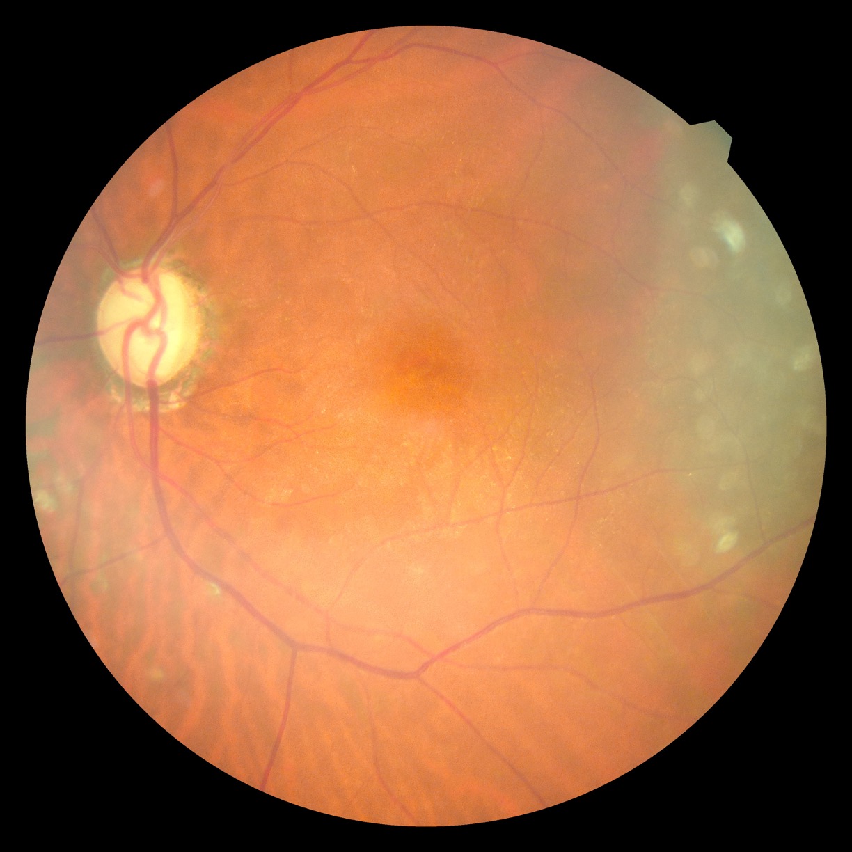 緑内障治療にレーザー治療という選択肢 - 芦屋市の眼科なら「いわみ眼科」